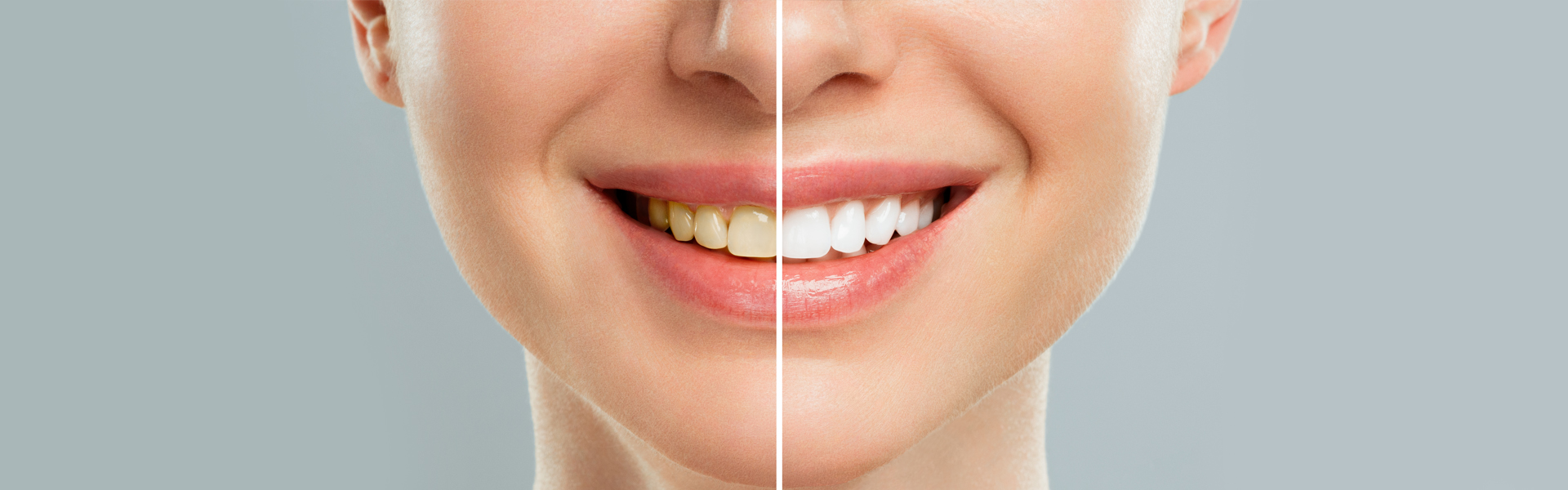 Teeth Whitening in Holmdel, NJ