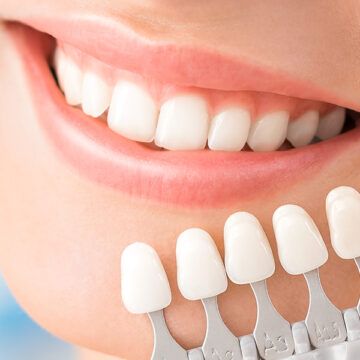 What is the typical recovery time after getting porcelain veneers?