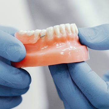 Are Dental Bridges a Long-Term Solution for Missing Teeth?